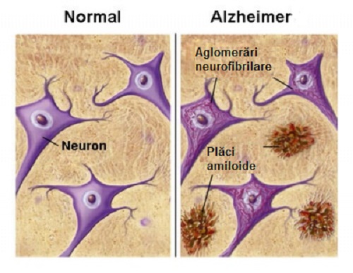 alzheimer Alzheimer