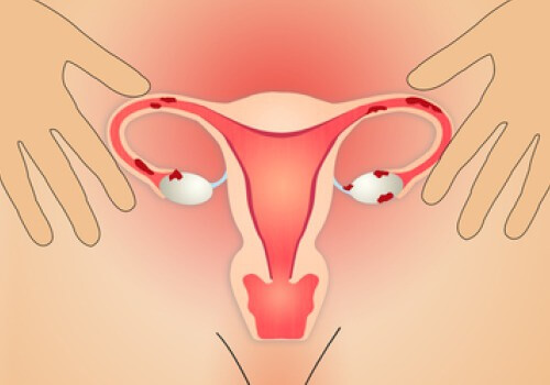 Tratezi endometrioza prin alimentație