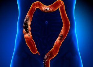 Grupe de alimente interzise în diverticuloză