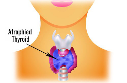 hipertiroidism-500x325-copy