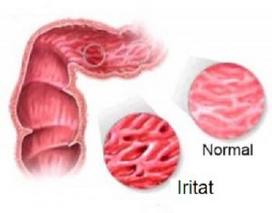 Intestin iritabil: atenție! Alimente interzise