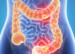 Obiceiuri care afectează intestinele