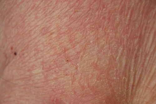 piele-3