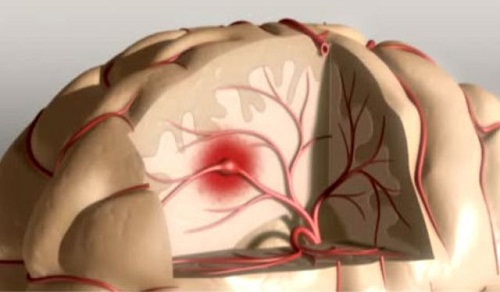 Cum să previi un accident vascular cerebral