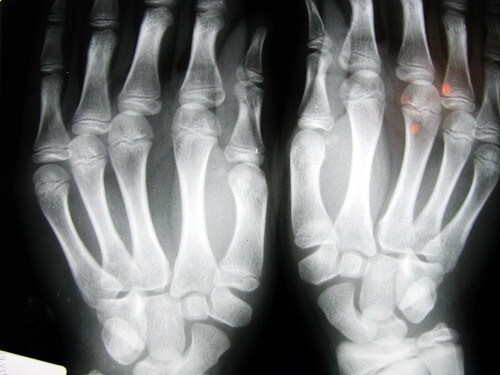 Radiografie după pocnitul degetelor
