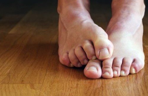 Remedii naturale pentru onicomicoză aplicate pe picioare