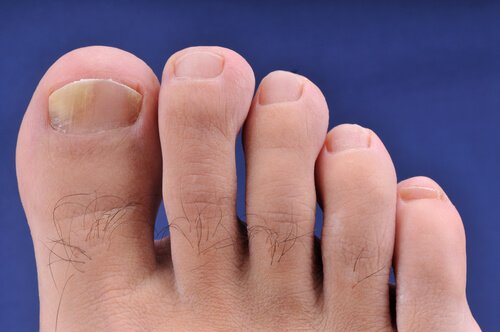 Tratarea ciupercii între degetele de la picioare