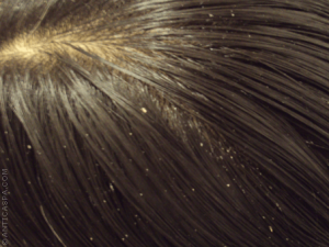 Remedii naturiste pentru mătreață