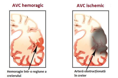 Tipuri de accident vascular cerebral