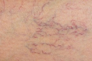6 tratamente pentru reducerea aspectului varicelor