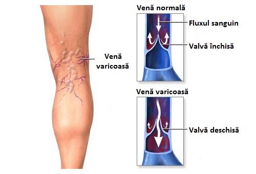 Ceai de la picioarele varicoase, Ce sunt varicele și cum se prezintă?