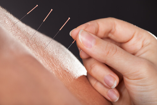 Acupunctura menopauza