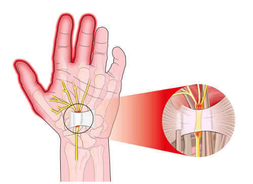 de ce ne amorțesc mâinile cum să anesteziați o articulație cu artrita