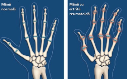 Artrită la mâini