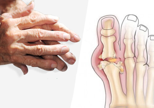 Câteva tipuri de tratament pentru artrită