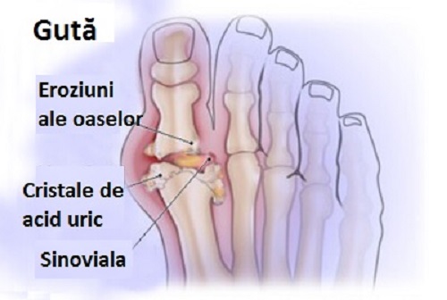 Gută la picior