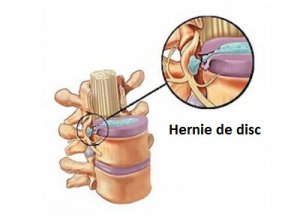 Hernie de disc – 5 simptome și cauzele acesteia