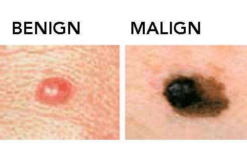 Cele mai importante informații despre alunițe