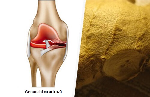 Informatii complete despre artroza sau osteoartrita