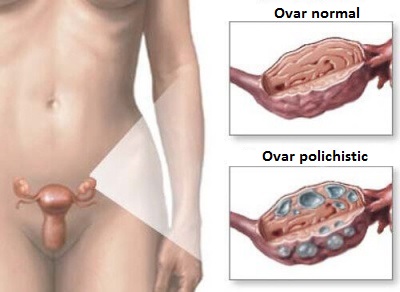 sindromul ovarian polichistic și greutatea pierde)