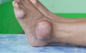 Plante medicinale care elimină acidul uric în exces