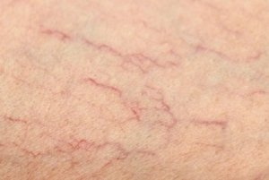 5 remedii pentru venele în pânză de păianjen