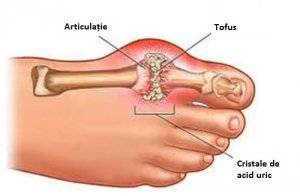 leac pentru inflamația genunchiului articulațiile mușchiului tendonului