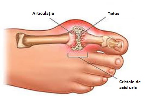 durere în toate articulațiile părții drepte a corpului edemul articular nu trece