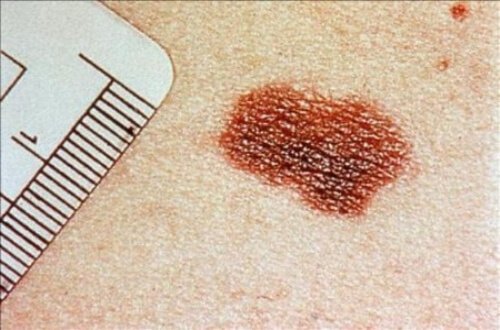Afecțiunile pielii pot indica prezența unor boli grave precum cancerul