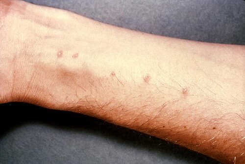 Afecțiunile pielii pot duce la apariția unor pete