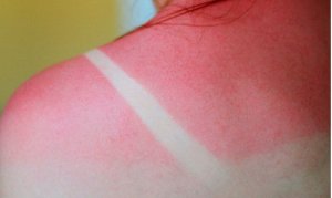Cele mai bune remedii pentru arsurile solare
