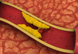 Varicoza i colesterol ridicat Creșterea colesterolului și varicozei