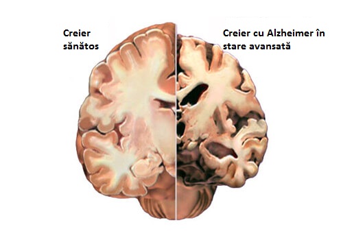 Creierul cu alzheimer