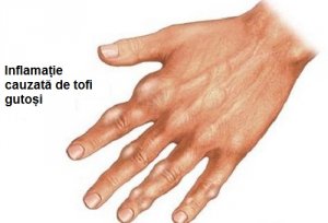 Cum reduci acidul uric prin metode naturale