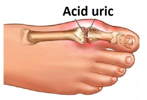 Cum reduci acidul aric din articulații