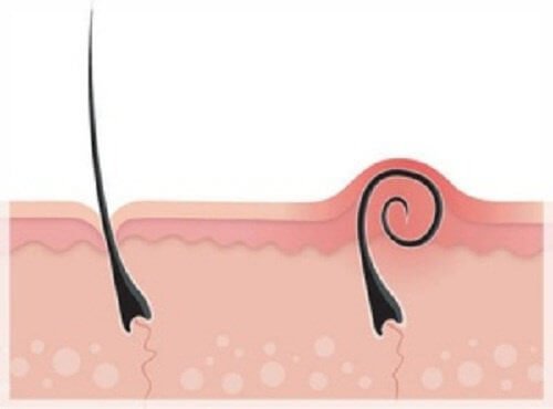 Firele de păr crescute sub piele: tratament