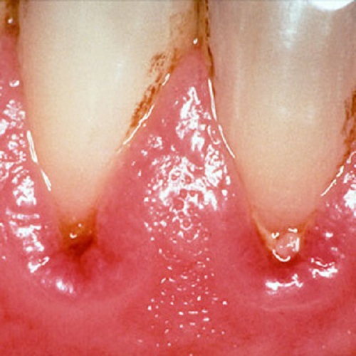 Formă de gingivită gravă