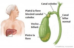 Pietre la fiere - cum le depistăm?