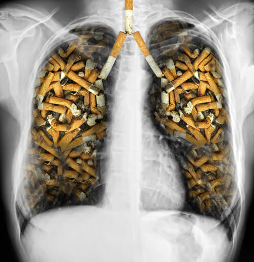 Plămânii sunt afectați de fumat