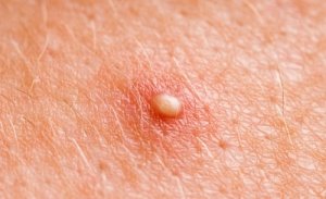 Remedii naturale pentru furuncule
