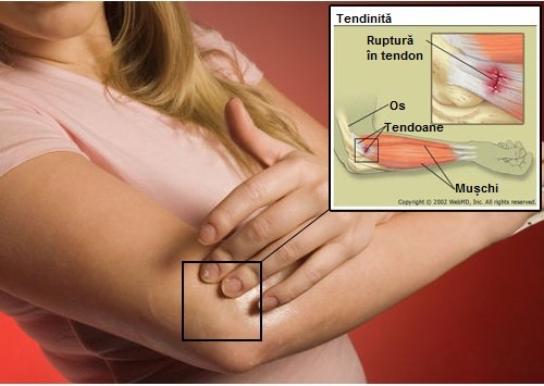 artroza cum să tratezi un genunchi boală articulară cu boala varului