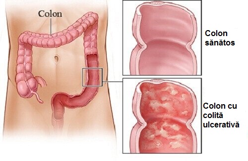 Colita sau Crohn? - Pierdeți în greutate cu boala crohn
