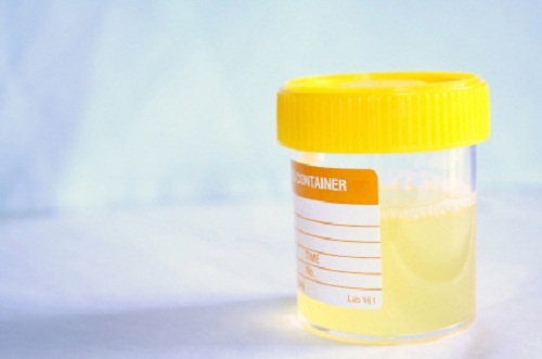 infectii-urinare Infecții Urinare