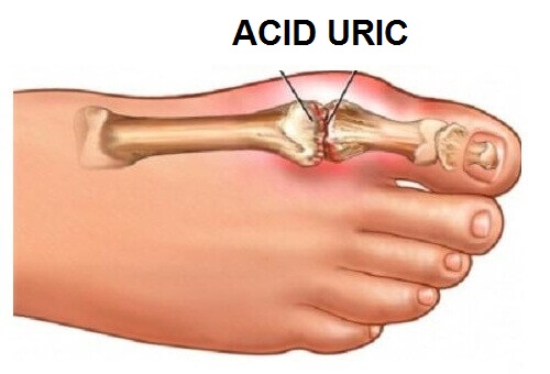 Acid uric, anghinare