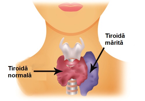 Nevoia de alimente care reglează tiroida mărită