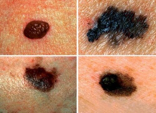 Aluniță afectată de cancerul de piele 