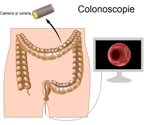 Informații despre cancerul de colon și colonoscopie