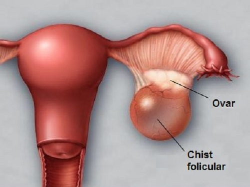 Durerile abdominale în partea stângă cauzate de ovar