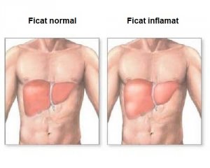 Inflamația ficatului – simptome și remedii