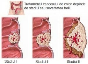 Informații despre cancerul de colon